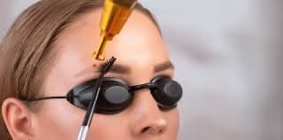 Cosmetic Tattoo Removal - Brows
